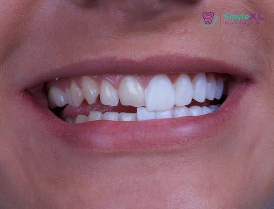 Porcelain veneers Kolhapur